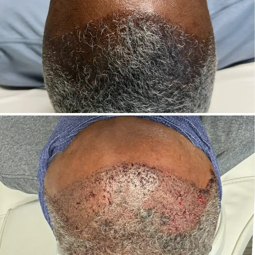 Hair Transplant before and after results at Gentle Giant Care in Atlanta, GA and Beverly Hills, CA