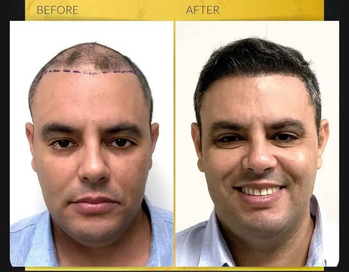 Three side-by-side images showing before and after results of a hair transplant procedure, highlighting improved hair density and restoration of the hairline on the patient