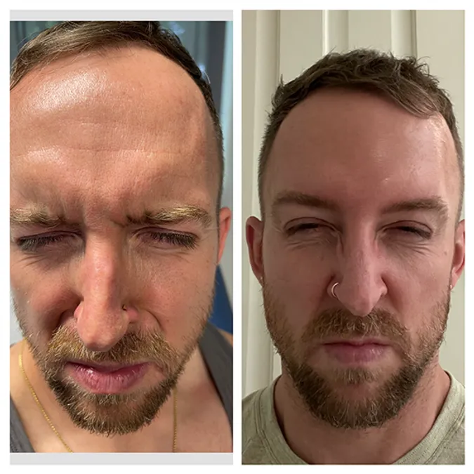 Botox image gallery 4