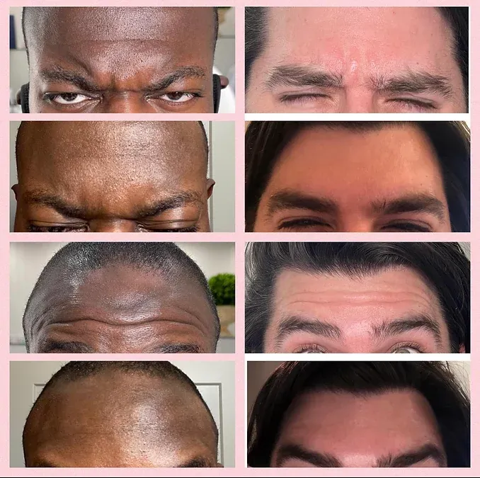 Botox treatment before and after results at Gentle Giant Care in Atlanta, GA and Beverly Hills, CA