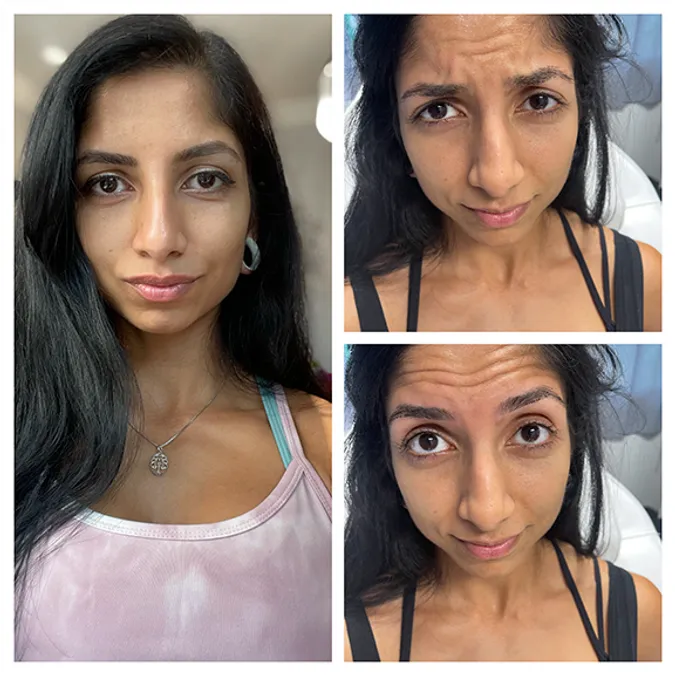 Botox image gallery