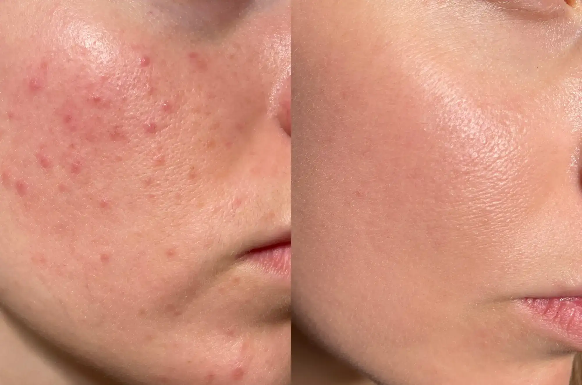Chemical peel treatment for acne at Gentle Giant Care