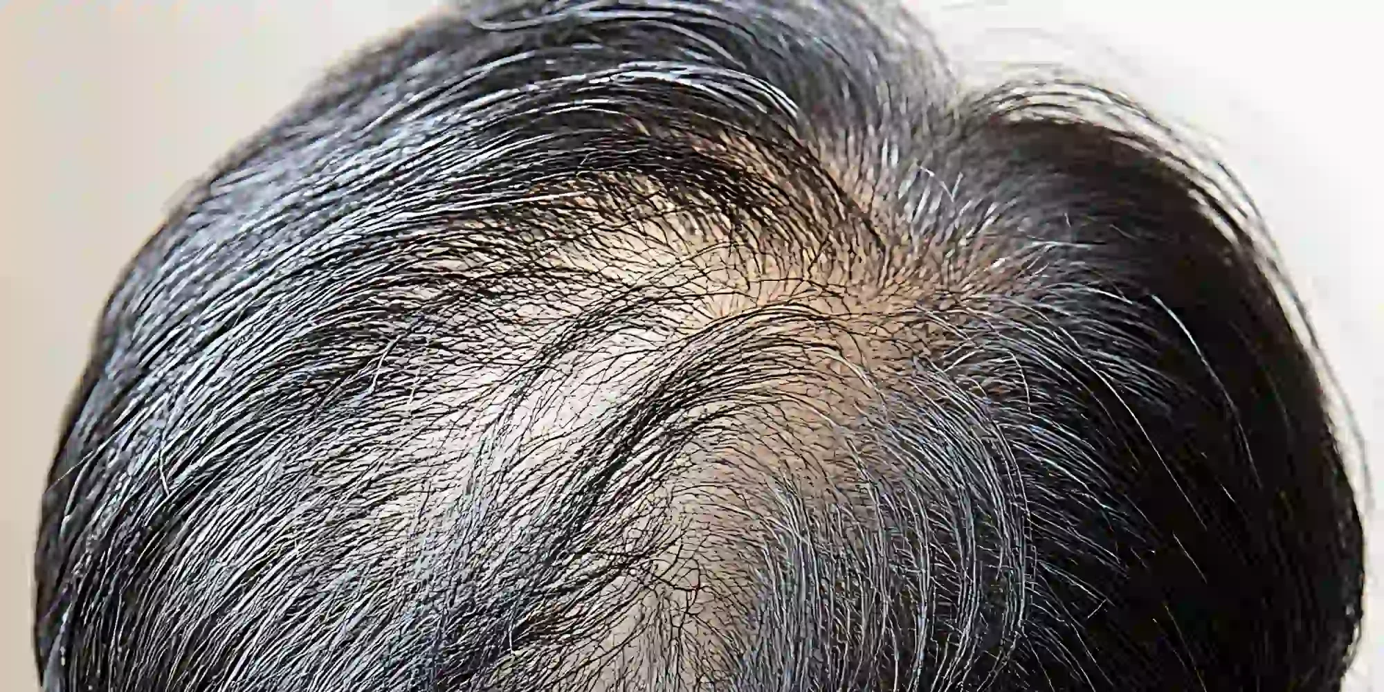 Hair Transplant treatment at Gentle Giant Care in Atlanta, GA and Beverly Hills, CA