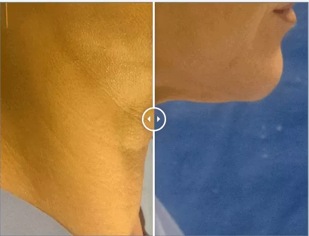 Endolift laser treatment results showing non-surgical face and neck lift transformation at Gentle Giant Care LLC in Palm Springs, CA.