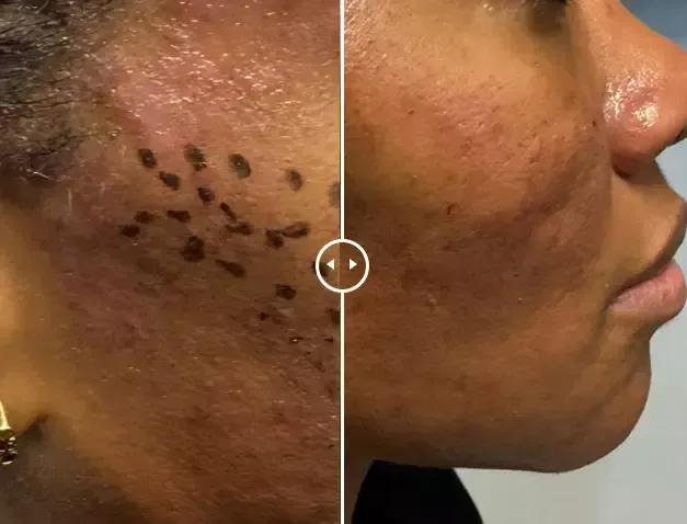 Endolift®-before-after-four-gentle-giant-care-llc-CA