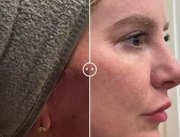 Endolift non-surgical facelift results showing improved skin elasticity and facial contouring at Gentle Giant Care LLC in Palm Springs, CA.