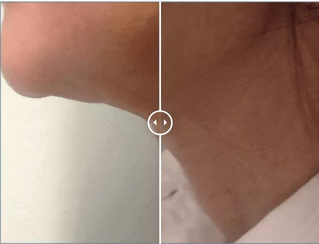 Endolift®-before-after-one-gentle-giant-care-llc-CA
