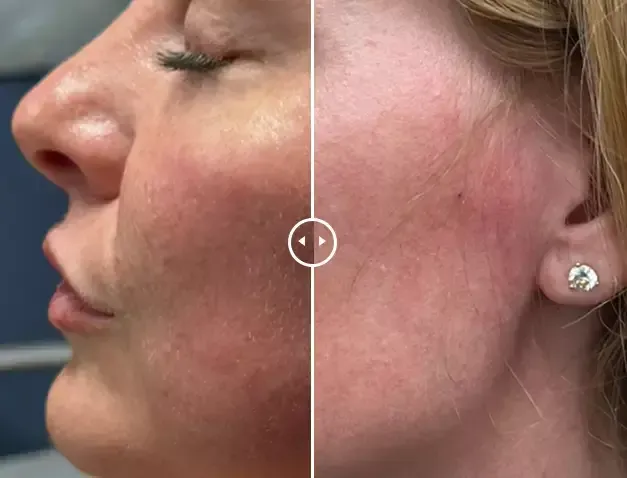 Endolift®-before-after-seven-gentle-giant-care-llc-CA