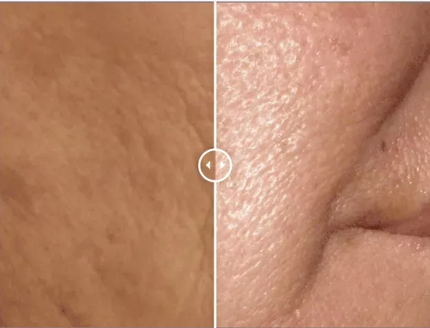 Split before-and-after close-up comparison of a person’s skin texture on the face showing smoother, tighter skin after Endolift® non-surgical laser skin tightening treatment