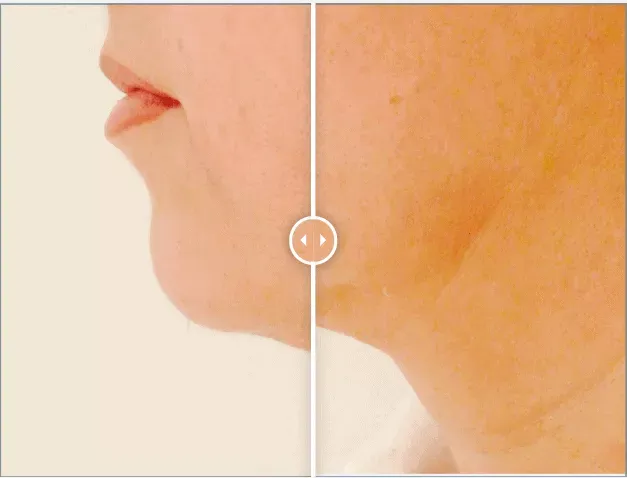 Side-by-side before and after comparison showing a person’s facial or neck area with visibly tighter, smoother skin after undergoing Endolift® laser skin tightening treatment