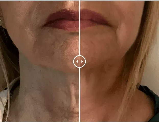 Side-by-side before and after comparison of a person’s jawline and lower face showing improved skin tightness and contour following Endolift® laser treatment.