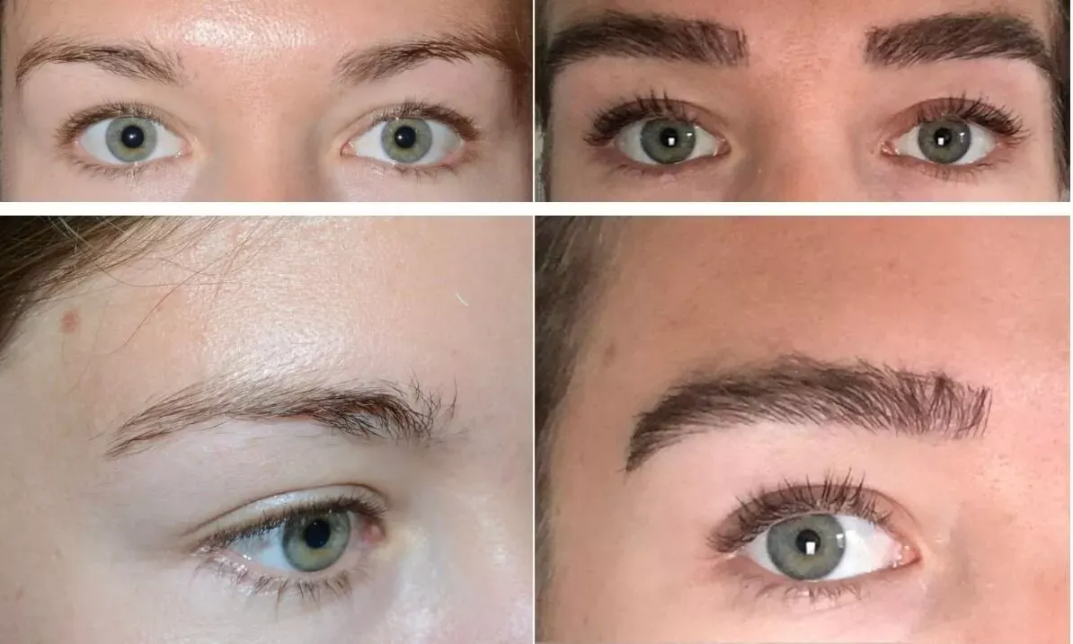 “Side‑by‑side before and after comparison showing improved hair density and coverage on a person’s scalp following hair restoration treatment at Gentle Giant Care LLC in Palm Springs, CA.”