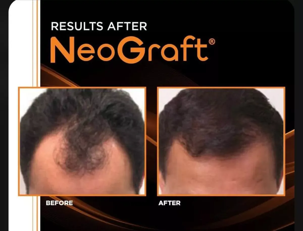 "Five side-by-side before and after images showing hair restoration results with improved hair density."