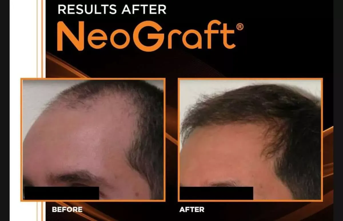 “Side‑by‑side before and after comparison showing a person’s scalp with improved hair density and fuller hair following hair restoration treatment at Gentle Giant Care LLC in Palm Springs, CA.”