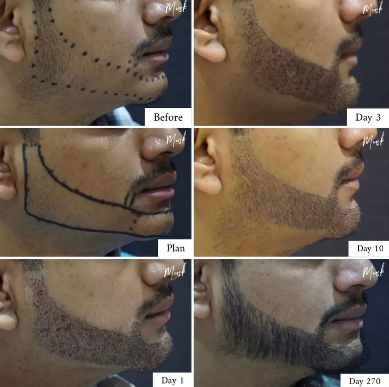 "Seven side-by-side before and after images showing hair restoration results with fuller hair growth."