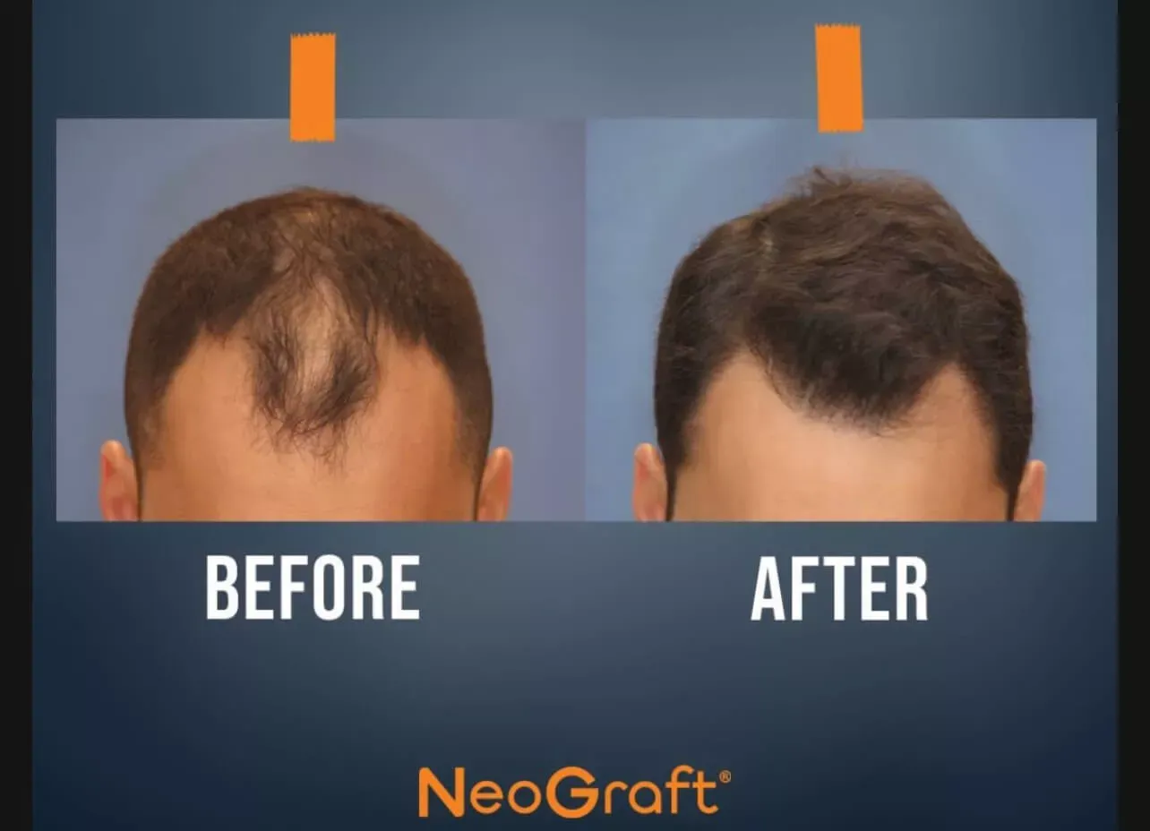 "Six side-by-side before and after images showing hair restoration results with increased hair density."