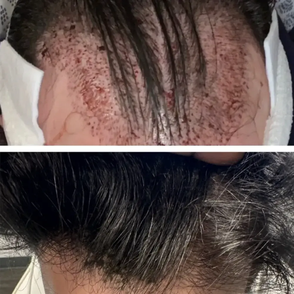 "Two side-by-side before and after images showing hair restoration results with improved hair density."