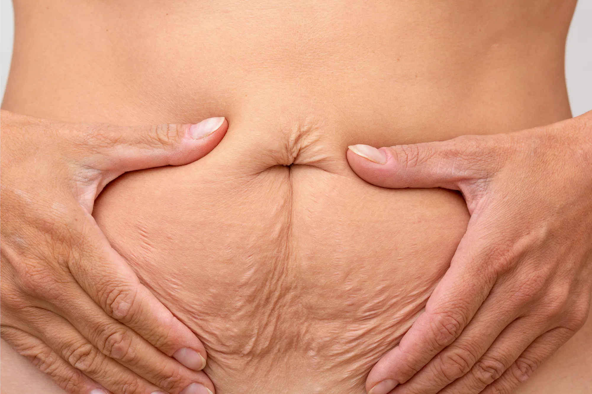 Woman pinching loose skin on her abdomen.