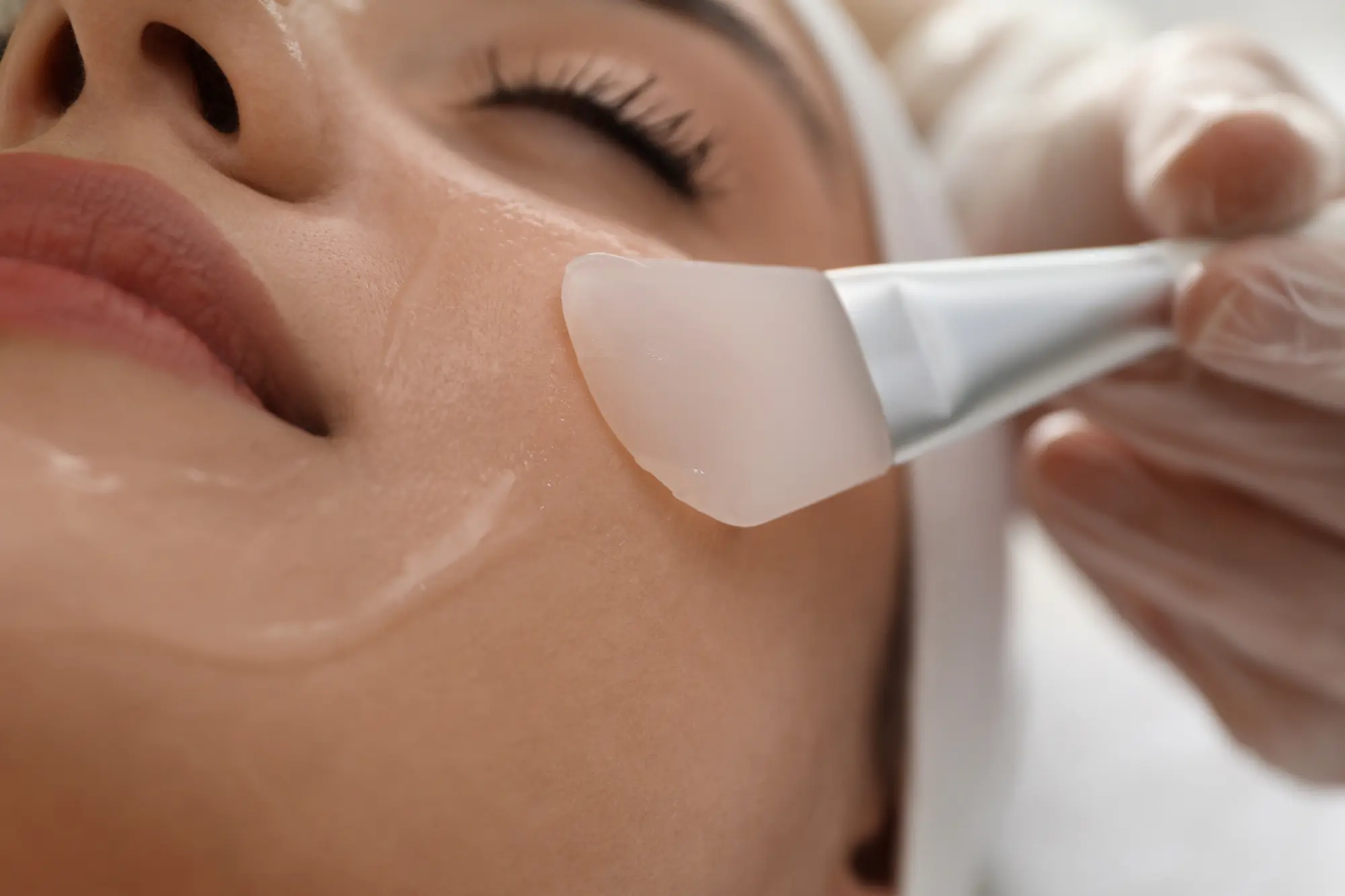 Facial chemical peel treatment for skin texture improvement and anti-aging at Gentle Giant Care LLC in Palm Springs, CA.