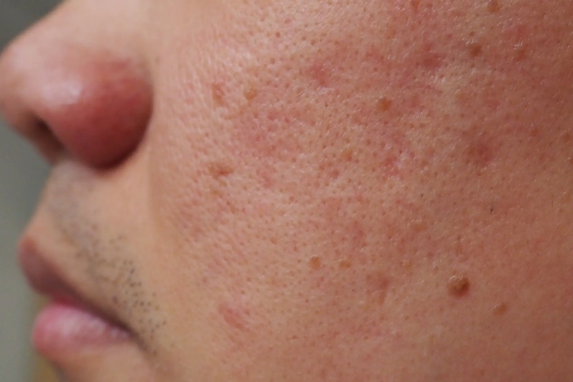 Chemical peel treatment for acne scars and skin texture refinement at Gentle Giant Care LLC in Palm Springs, CA.