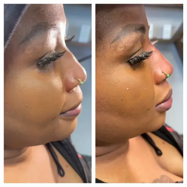Dermal filler treatment 2