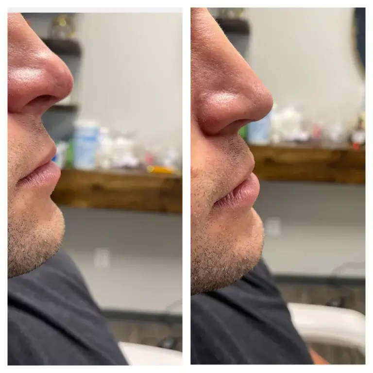 Dermal filler before and after