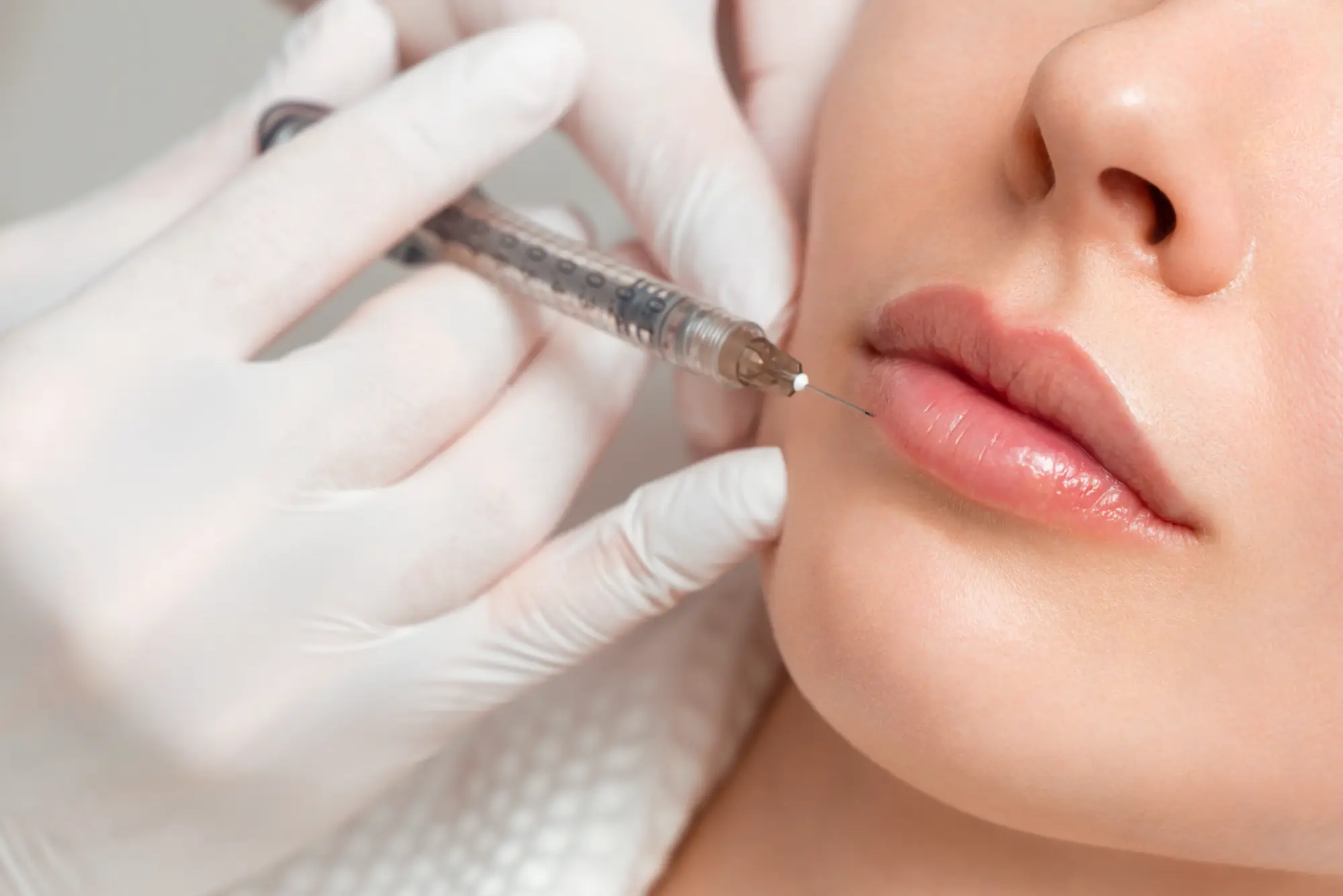 “Dermal filler treatment procedure at Gentle Giant Care LLC in Atlanta, Georgia — showing what happens during a session, including consultation, preparation, and administration of cosmetic filler injections to enhance facial features and improve volume and contour.”