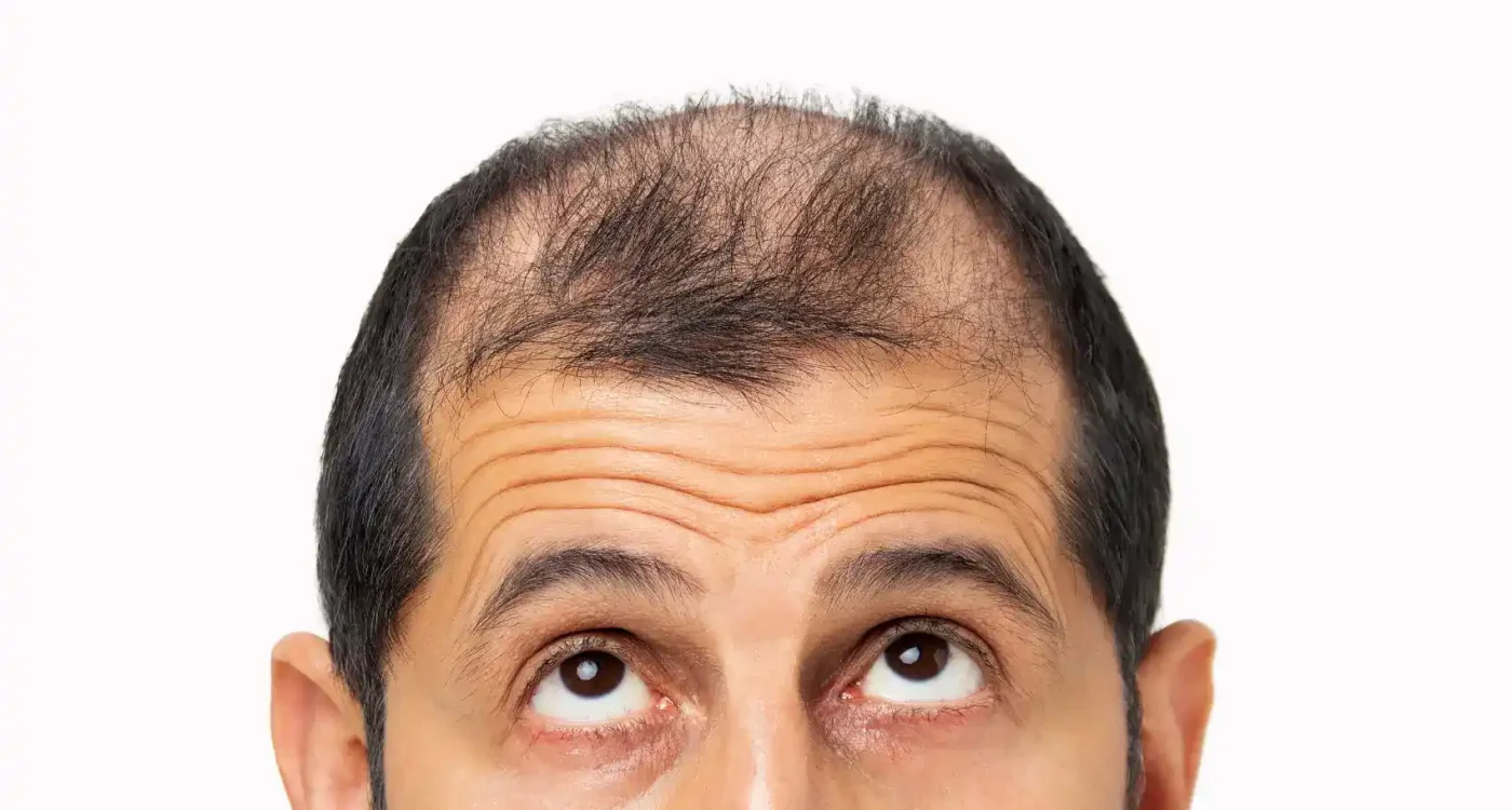 a man's before hair restoration treatment