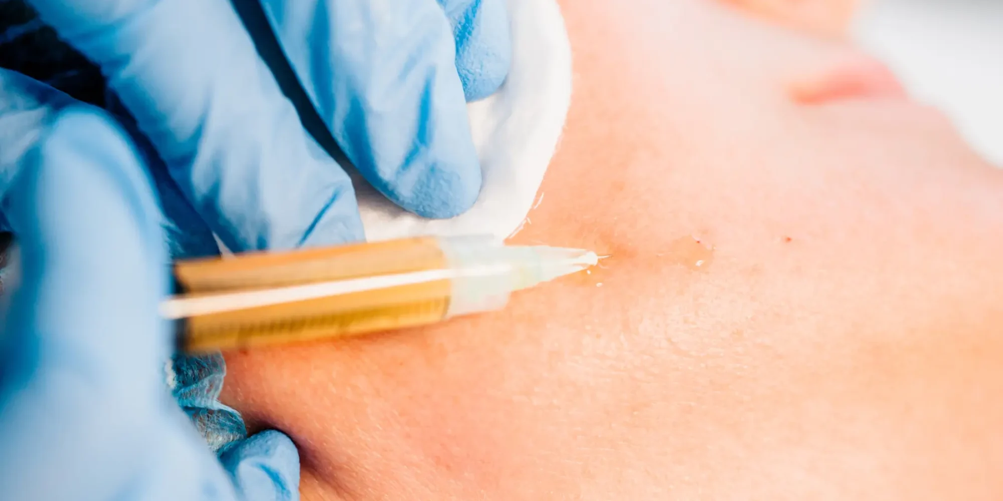 Stem cell and PRP facial injection treatment at Gentle Giant Care LLC to improve skin texture and tone.
