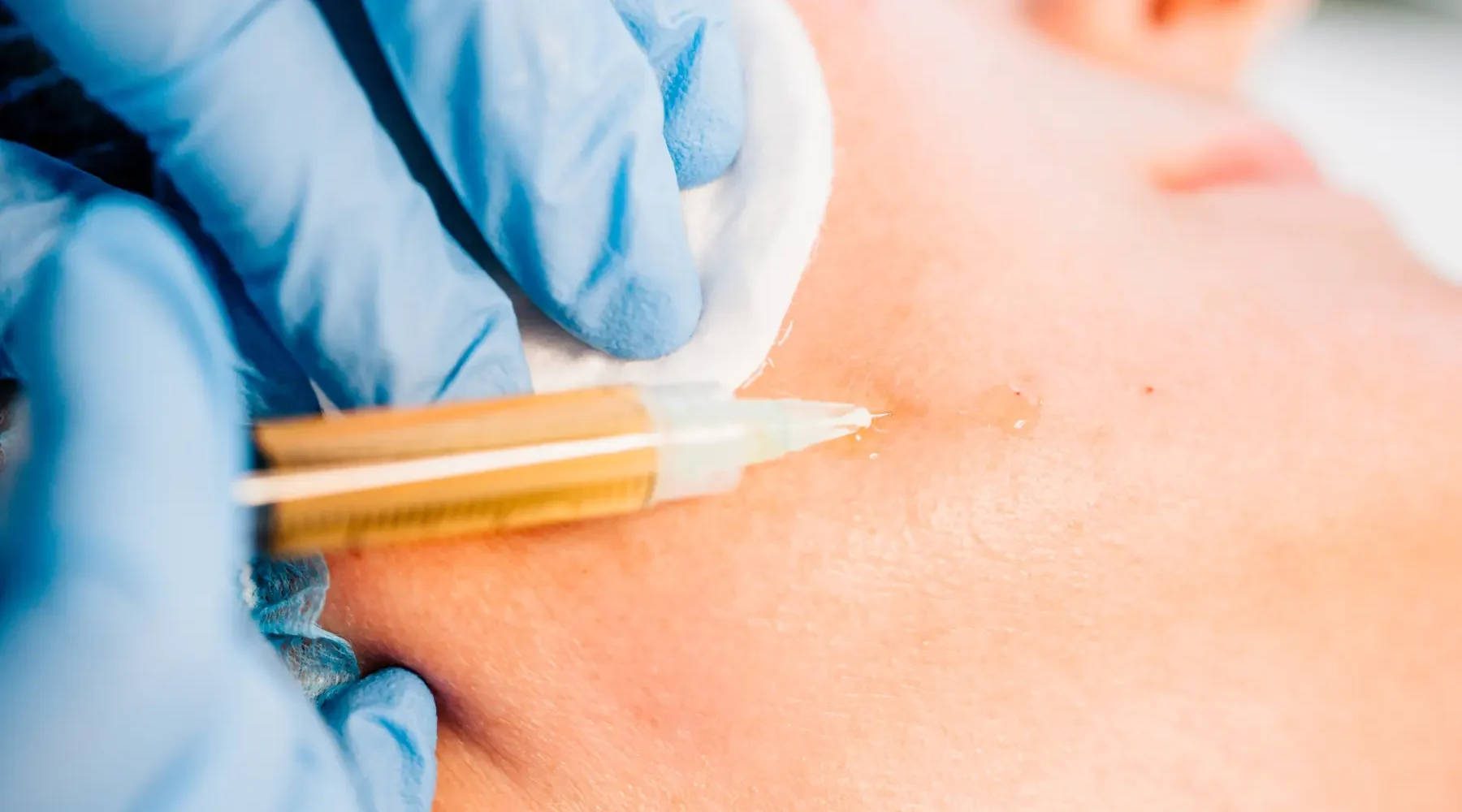 “Stem cell and PRP injections for the face at Gentle Giant Care LLC in Palm Springs, California — a clinician administering regenerative facial injections to support tissue repair, rejuvenation, and anti‑aging effects.”