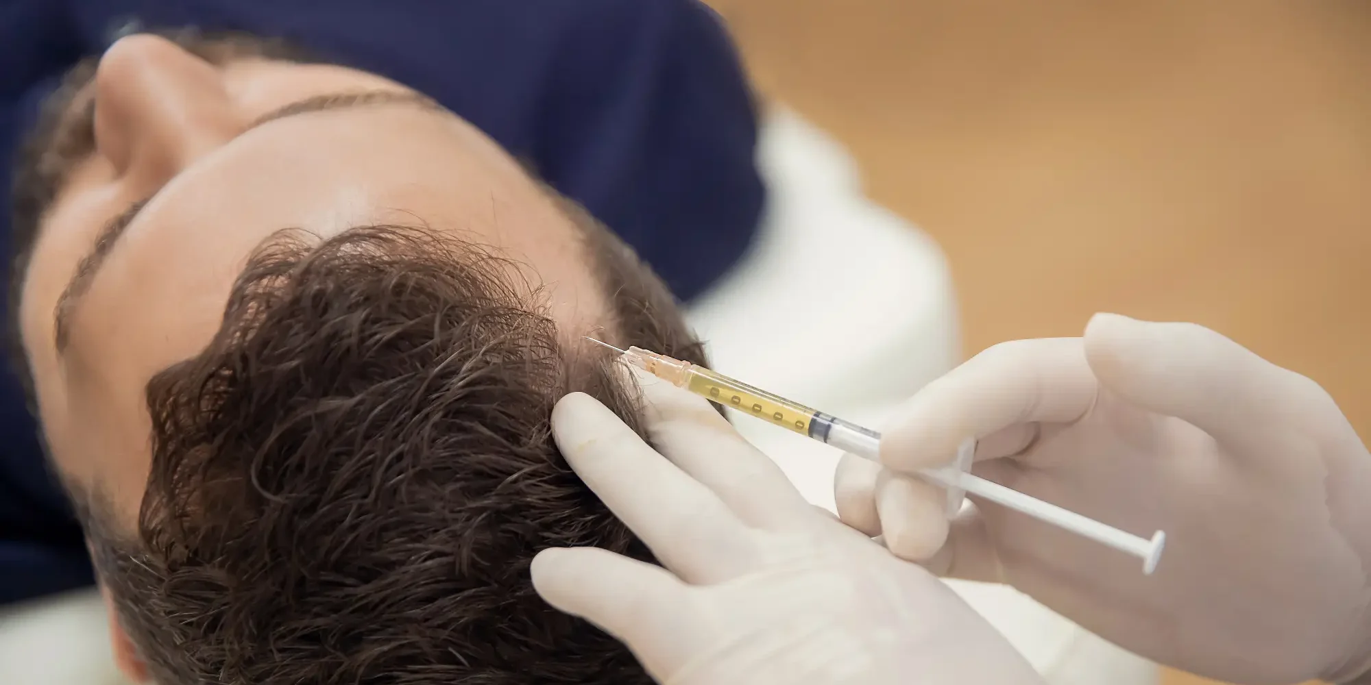 Close-up of a doctor administering a hair restoration injection into a person's scalp